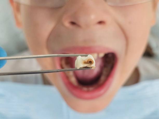 Best Emergency Broken Tooth Repair in Hudson, NC